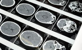 Traumatic Brain Injuries – Signs, Types, and Compensation